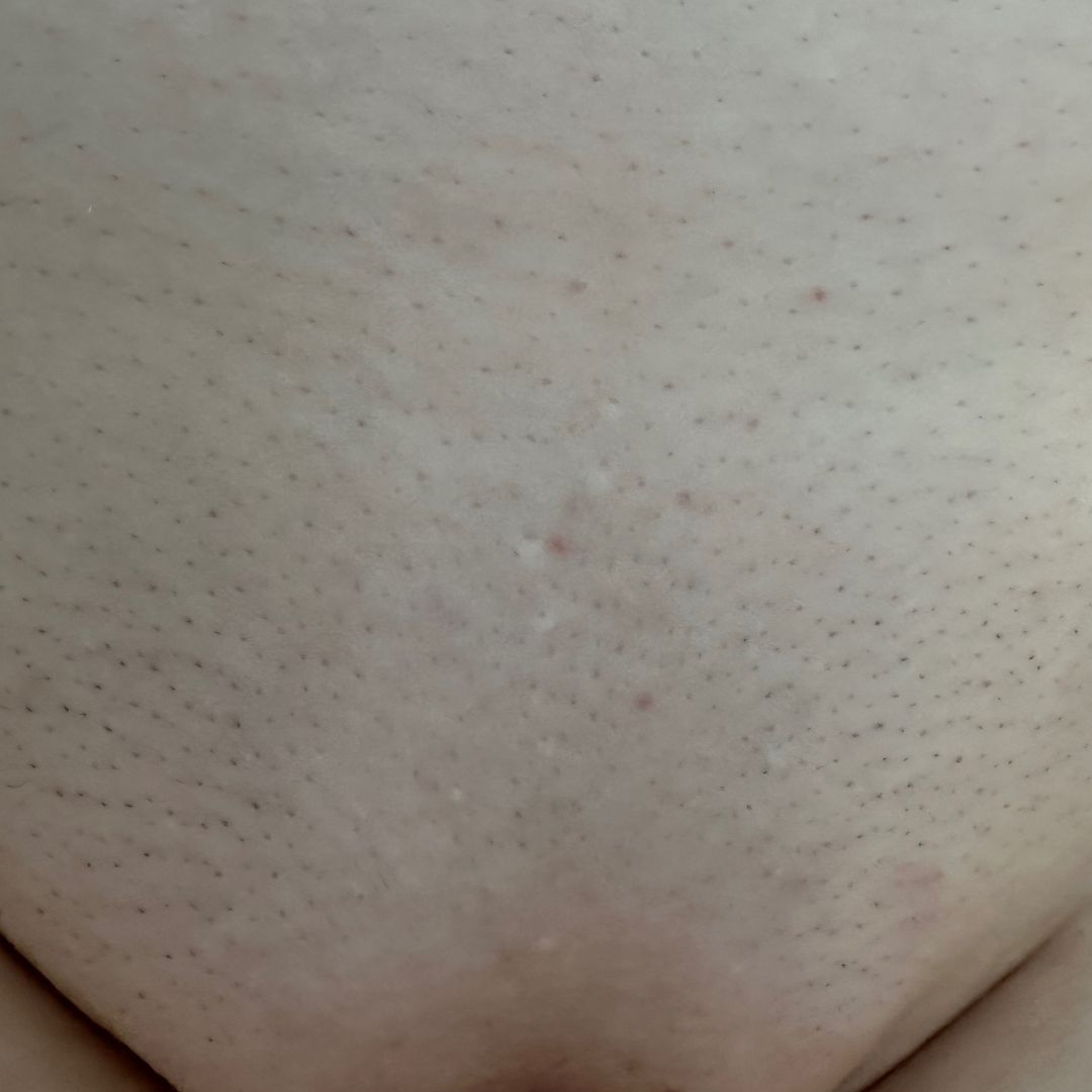 Bikini predel po sedmi terapiji laserja