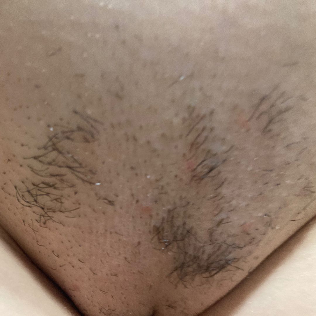 Bikini predel pred tretjo terapijo laserja